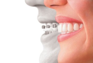 Invisalign Clear Braces in Burlington ON - Orthodontic Treatment